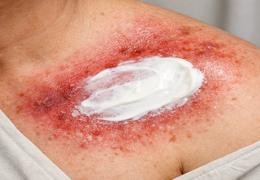 Flamigel RT: qué es, indicaciones y guía de uso para reacciones cutáneas por radioterapia